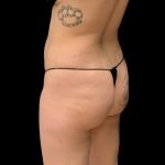 Brazilian Butt Lift Before & After Patient #6105