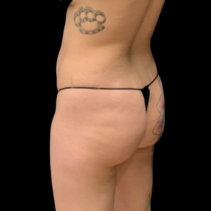 Brazilian Butt Lift Before & After Patient #6105