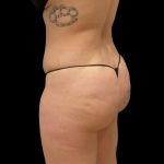Brazilian Butt Lift Before & After Patient #6105