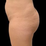 Brazilian Butt Lift Before & After Patient #6106