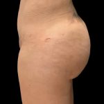 Brazilian Butt Lift Before & After Patient #6106