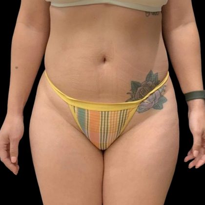 Brazilian Butt Lift Before & After Patient #6126