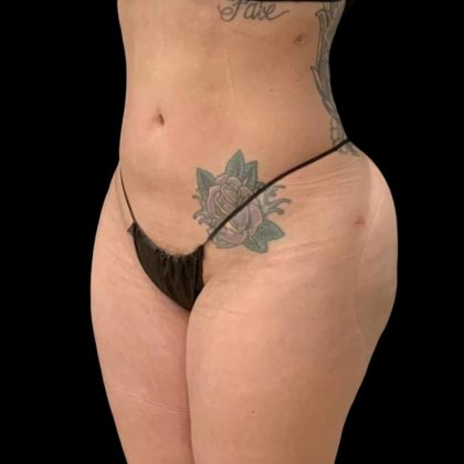 Brazilian Butt Lift Before & After Patient #6126