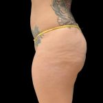 Brazilian Butt Lift Before & After Patient #6126