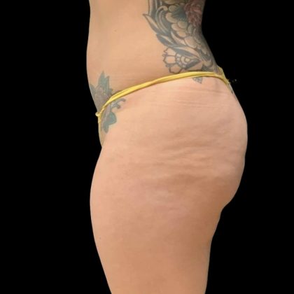 Brazilian Butt Lift Before & After Patient #6126