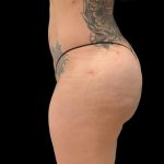 Brazilian Butt Lift Before & After Patient #6126