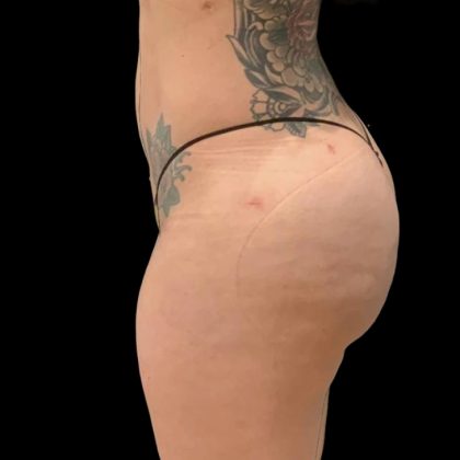 Brazilian Butt Lift Before & After Patient #6126