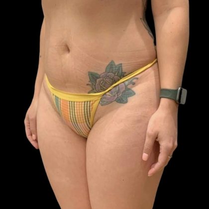 Brazilian Butt Lift Before & After Patient #6126