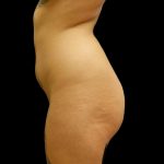 Brazilian Butt Lift Before & After Patient #6181