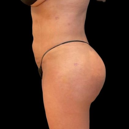 Brazilian Butt Lift Before & After Patient #5951