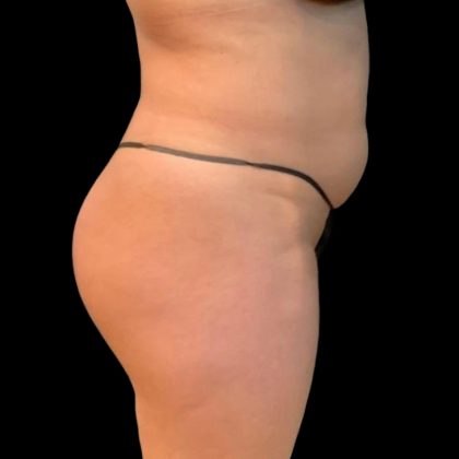 Brazilian Butt Lift Before & After Patient #5951