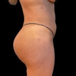 Brazilian Butt Lift Before & After Patient #5951