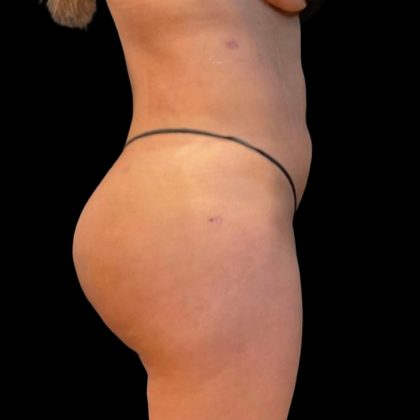 Brazilian Butt Lift Before & After Patient #5951