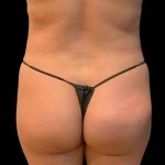 Brazilian Butt Lift Before & After Patient #5951