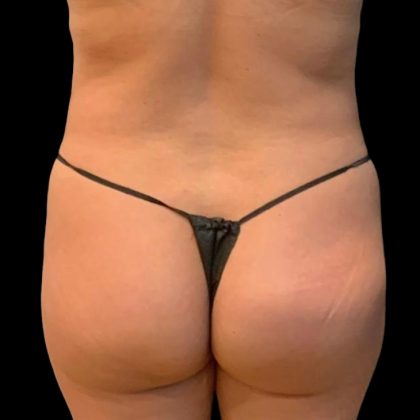 Brazilian Butt Lift Before & After Patient #5951