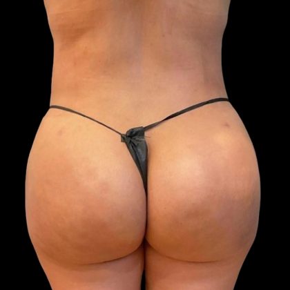 Brazilian Butt Lift Before & After Patient #5951