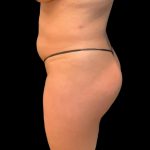 Brazilian Butt Lift Before & After Patient #5951