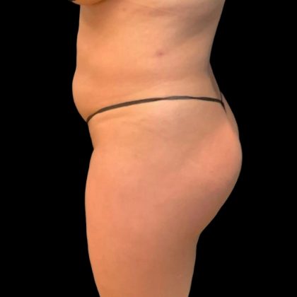 Brazilian Butt Lift Before & After Patient #5951