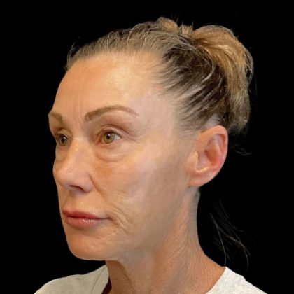 Blepharoplasty Before & After Patient #6496