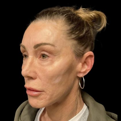 Blepharoplasty Before & After Patient #6496