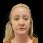 Facelift Before & After Patient #6488