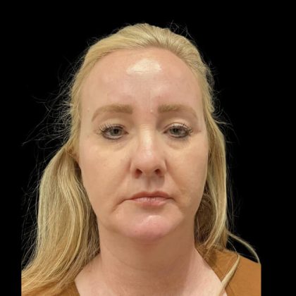 Facelift Before & After Patient #6488