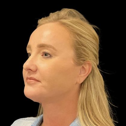 Facelift Before & After Patient #6488