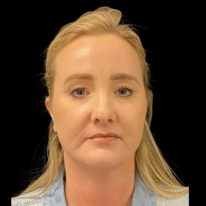 Facelift Before & After Patient #6488