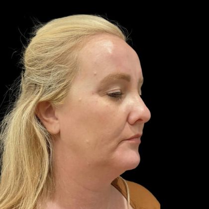 Facelift Before & After Patient #6488