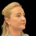 Facelift Before & After Patient #6488