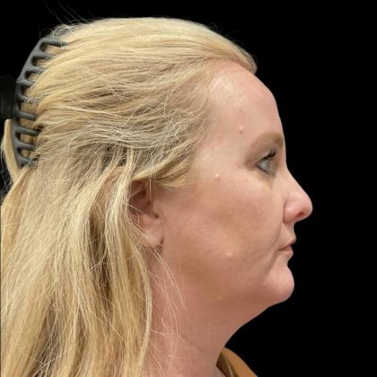 Facelift Before & After Patient #6488