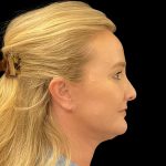 Facelift Before & After Patient #6488