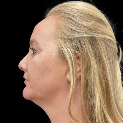 Facelift Before & After Patient #6488