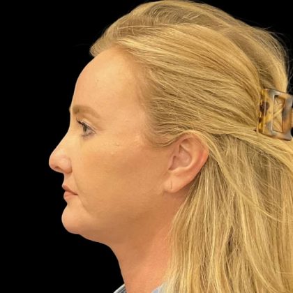 Facelift Before & After Patient #6488