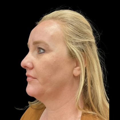 Facelift Before & After Patient #6488