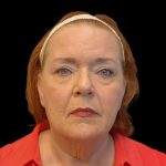 Facelift Before & After Patient #6491