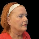 Facelift Before & After Patient #6491