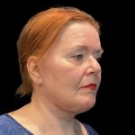 Facelift Before & After Patient #6491