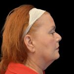 Facelift Before & After Patient #6491