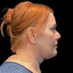 Facelift Before & After Patient #6491