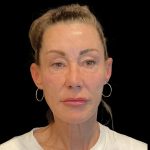 Facelift Before & After Patient #6492
