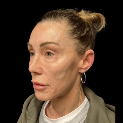 Facelift Before & After Patient #6492