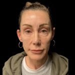 Facelift Before & After Patient #6492