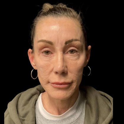 Facelift Before & After Patient #6492