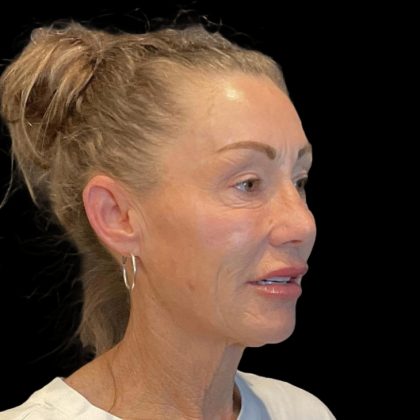 Facelift Before & After Patient #6492