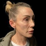 Facelift Before & After Patient #6492