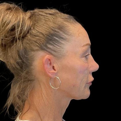 Facelift Before & After Patient #6492