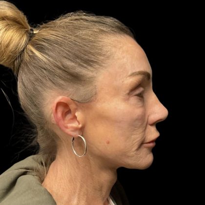 Facelift Before & After Patient #6492