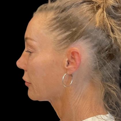 Facelift Before & After Patient #6492