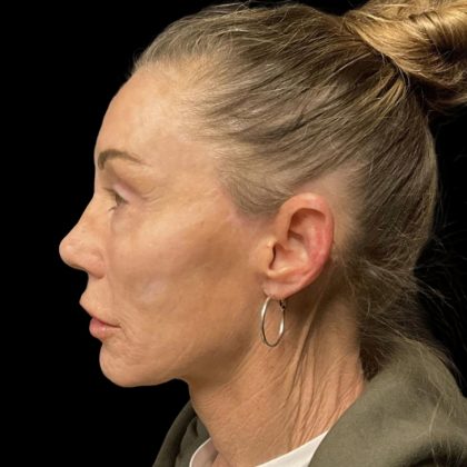 Facelift Before & After Patient #6492